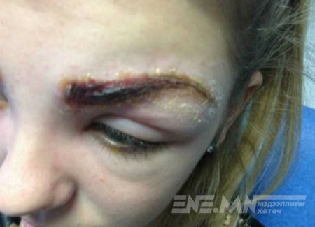Хөмсгөө шивүүлж, гоё болох гэсэн 17-той охин мангас болон хувирчээ