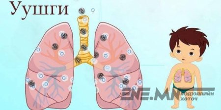 “Уушгины хатгалгаа өвчинтэй тэмцэх дэлхийн өдөр" тохиож байна