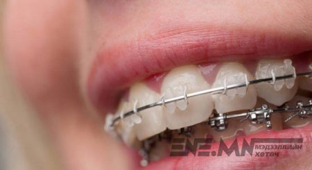 Хэлний хөвч богино байх нь шүдний гажиг үүсгэдэг