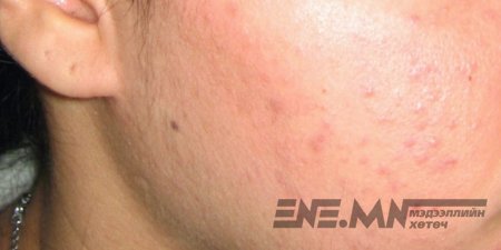 Улаан батгыг хоолоор эмчлэх нь