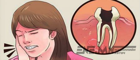 Гэрийн нөхцөлд шүдний өвдөлтийг түргэн намдаах арга