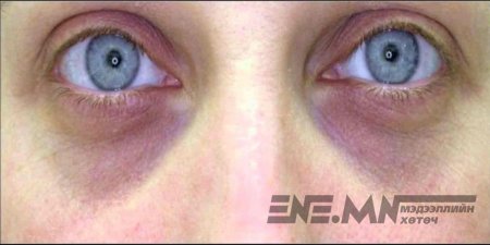 Нүдний доорх хөхрөлтийг арилгах арга