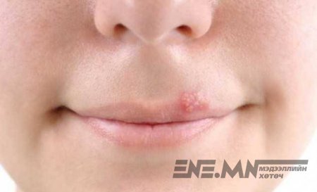 Таны уруулан дээр хомхой долоосон байна уу? Тэгвэл 1 хоногийн дотор арилгах нууц аргуудаас