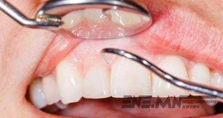 Шүдний мэргэжлийн эмчээр үе үе цэвэрлэгээ хийлгэж байхыг зөвлөж байна